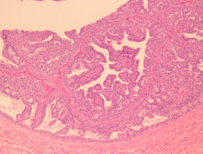 Hidradenoma papilliferum pathology