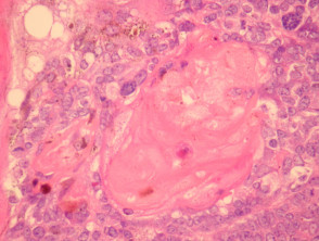 Melanocytic matricoma pathology