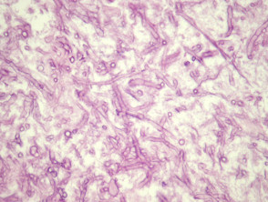 Mucormycosis pathology
