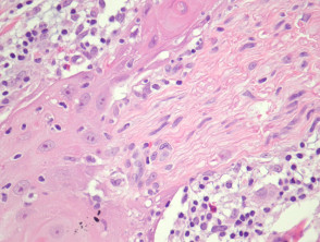 Squamous cell carcinoma pathology