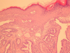 Erosive papillomatosis of the nipple pathology