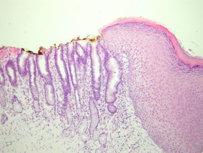Omphalomesenteric duct remnant pathology