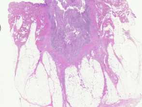 Pilonidal sinus pathology