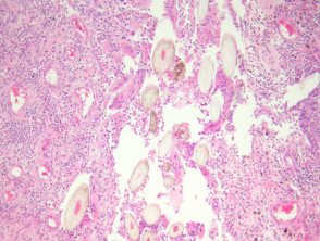 Pilonidal sinus pathology