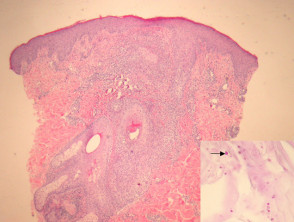 Malassezia folliculitis pathology