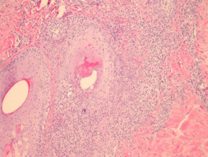 Malassezia folliculitis pathology
