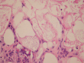 Poststeroid panniculitis pathology