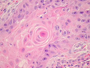 Moderately differentiated squamous cell carcinoma pathology