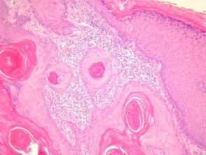 Well differentiated squamous cell carcinoma pathology