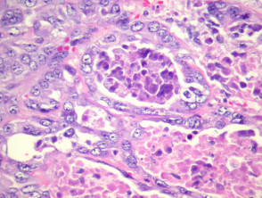 Sebaceous carcinoma pathology
