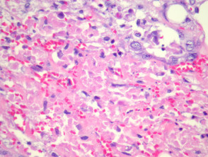 Sebaceous carcinoma pathology