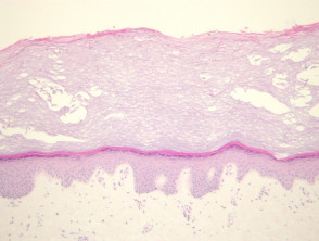 Tinea nigra pathology