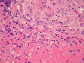Cutaneous tuberculosis   pathology