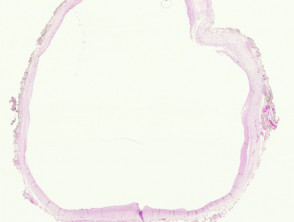 Urachal cyst pathology