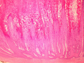 Verruca vulgaris   pathology