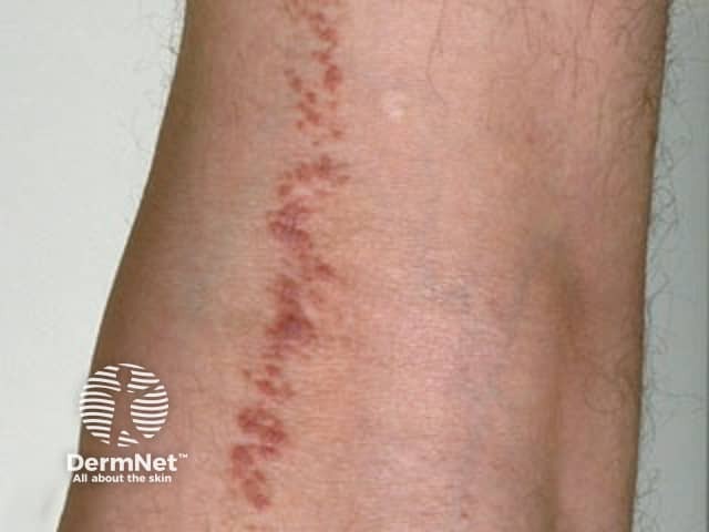 Lichen striatus/blaschkitis