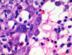 Herpes virus infection pathology
