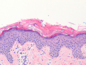 Pityriasis versicolor pathology