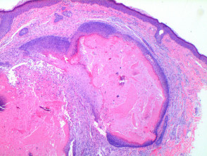 Pilomatricoma pathology