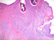 Acne keloidalis nuchae pathology