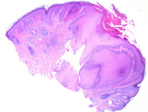 Chondrodermatitis nodularis helicis pathology