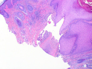 Chondrodermatitis nodularis helicis pathology
