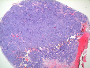 Cylindroma  pathology