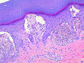 Dermatitis herpetiformis pathology