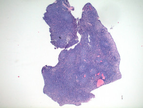 Eccrine spiradenoma  pathology