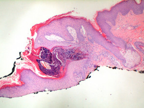 Elastosis perforans serpiginosa pathology