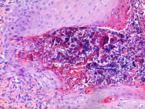Elastosis perforans serpiginosa pathology
