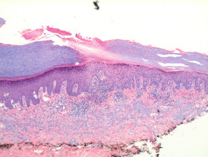 Porokeratosis pathology