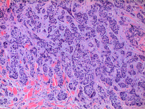 Cutaneous metastatic adenocarcinoma pathology