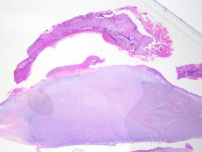Leiomyosarcoma  pathology