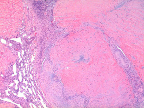 Myofibroma pathology