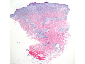 Scabies pathology