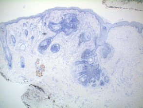 Trichoepithelioma pathology, Ber-EP4 stain