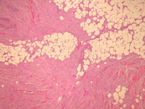 Dermatofibrosarcoma protuberans pathology