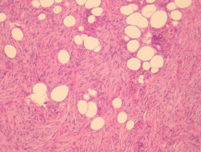 Dermatofibrosarcoma protuberans pathology