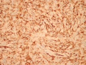 Dermatofibrosarcoma protuberans pathology: CD34 stain