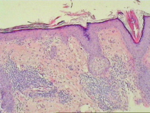 Pathology of discoid lupus erythematosus