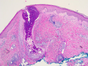 Eosinophilic pustular folliculitis pathology