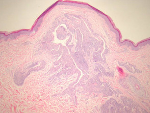 Glomus tumour pathology