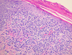 Pityriasis lichenoides et varioliformis acuta (PLEVA) pathology