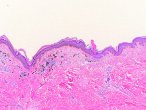 Pigmented porokeratosis histology