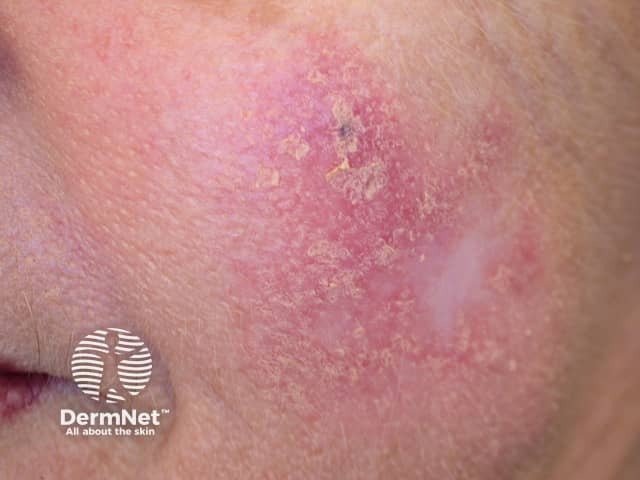 Squamous cell carcinoma in situ