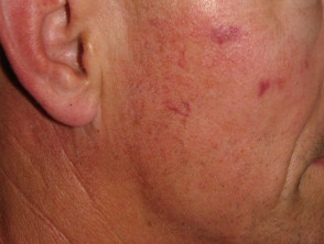 Pulse dye laser for telangiectasia, day after treatment