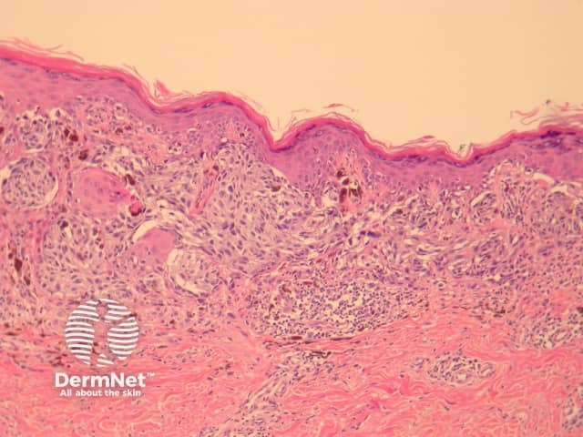 Radial growth phase superficial spreading melanoma