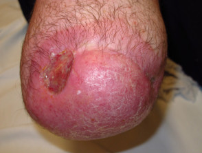 Amputation stump dermatoses