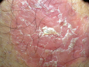 Skin problems affecting an amputation stump